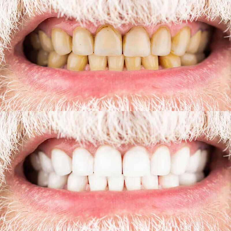 Purple Teeth Whitening Serum